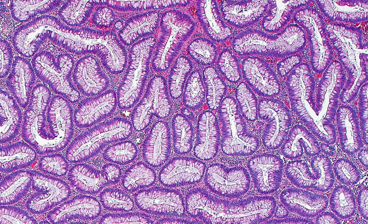 Tubular Adenoma ~ #GIpath #colon #pathology #PathArt