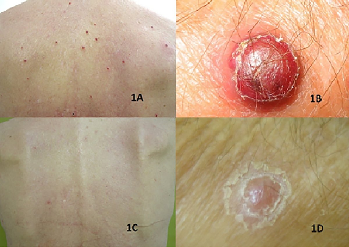 Learn more about this recently published article from Leukemia Research Reports Is Bartonella sp. infection relevant in hematological malignancies in HIV-negative patients? A literature review Read now: spkl.io/60164IhdE