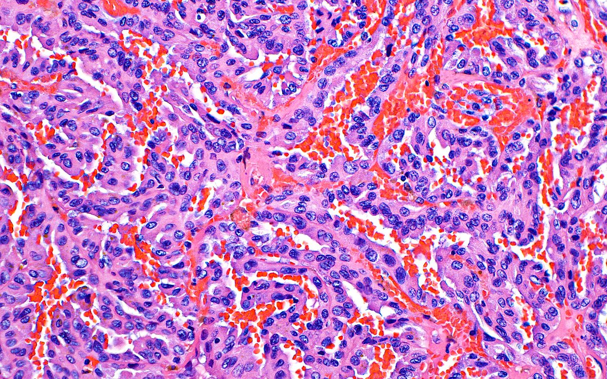 Papillary Renal Cell Carcinoma ~ #GUpath #kidney #pathology #PathArt