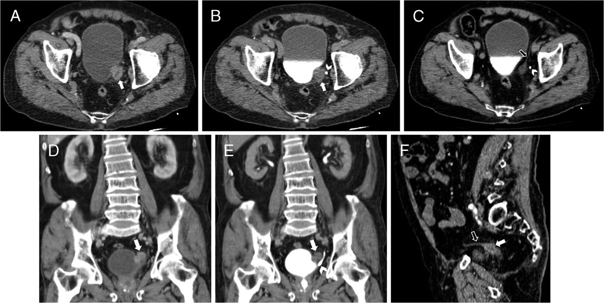 Current Issue: 18F-FDG PET–Positive Large Pelvic Granuloma Mimicking Malignant Bladder Tumor dlvr.it/T4ZtJ0