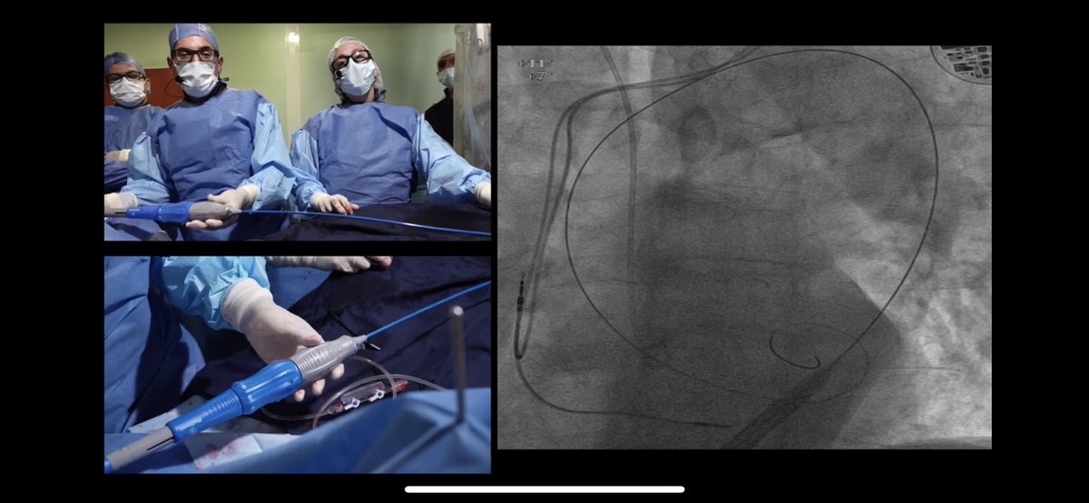 Matias Sztejfman (@msztejfman) on Twitter photo See our last live case📹. #TAVR with SEV in patient with CKD. EVOLUT PRO PLUS WITH MINIMAL AMOUNT OF CONTRAST ECHO GUIDED performed be a MIL Vero Gonzalez @SOLACI3 youtu.be/_2a11CRFPck?fe… vía <a href="/YouTube/">YouTube</a>
<a href="/JGMD63/">Juan Gaspar</a> <a href="/GuiAttizzaniMD/">Gui Attizzani</a> <a href="/PCRonline/">PCRonline 🫀</a> <a href="/Drroxmehran/">Dr Roxana Mehran</a> See our last live case📹. #TAVR with SEV in patient with CKD. EVOLUT PRO PLUS WITH MINIMAL AMOUNT OF CONTRAST ECHO GUIDED performed be a MIL Vero Gonzalez @SOLACI3 youtu.be/_2a11CRFPck?fe… vía <a href="/YouTube/">YouTube</a>
<a href="/JGMD63/">Juan Gaspar</a> <a href="/GuiAttizzaniMD/">Gui Attizzani</a> <a href="/PCRonline/">PCRonline 🫀</a> <a href="/Drroxmehran/">Dr Roxana Mehran</a>