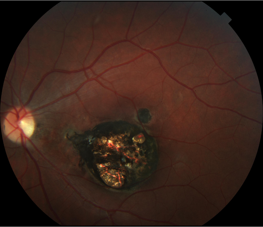 UCL & Moorfields Education (@uclmoorfieldsed) on Twitter photo Our #Moorfields international #uveitis symposium now has it's full programme confirmed❗️Take a look checkout.moorfields.nhs.uk/product?catalo… and book your space for 11-13 July <a href="/RoySocMed/">The Royal Society of Medicine</a> London. Our #Moorfields international #uveitis symposium now has it's full programme confirmed❗️Take a look checkout.moorfields.nhs.uk/product?catalo… and book your space for 11-13 July <a href="/RoySocMed/">The Royal Society of Medicine</a> London.