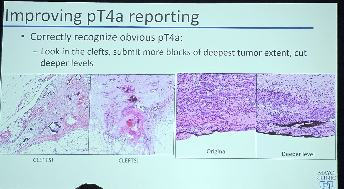 Colorrectal cancer - pT4a #gipath #pathology #USCAP2024