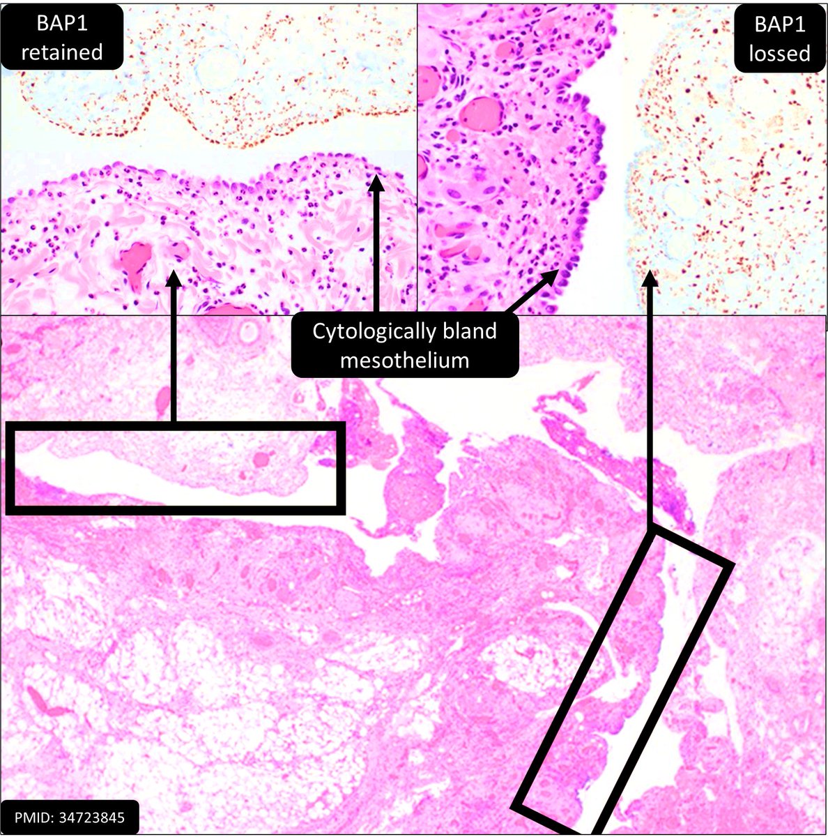 (-) BAP1, bland mesothelial lining; benign or malignant?
#gynpath #pulmpath #pathresidents #pathtwitter #USCAP2024 #USCAP24 #USCAP