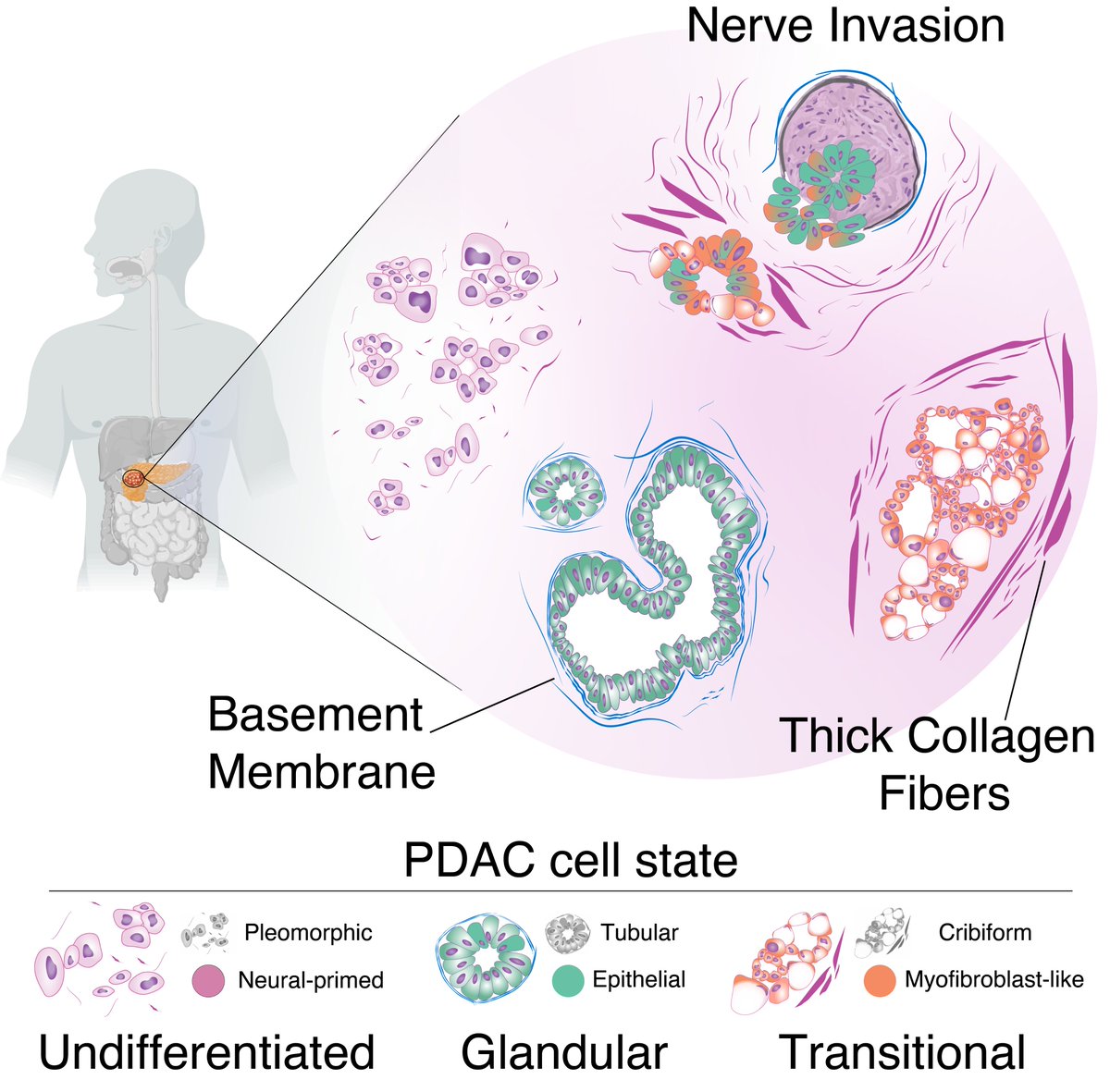 PDAC: A Tumor of Many Faces, Unveiling its Shape-Shifting Nature and Nerve Invasion Abilities. Read the new work published on @Cancer_Cell from our @ItalianPCC member Dr. Giuseppe Diaferia with Dr. Gioacchino Natoli. 👉 authors.elsevier.com/c/1ioDA5TA51hO…