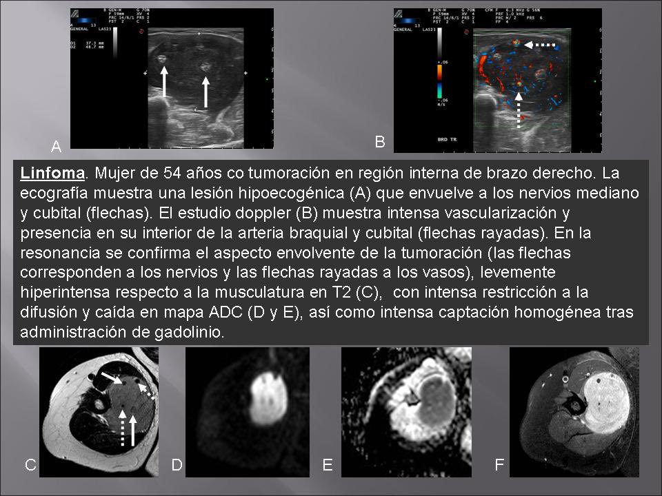 Nuevo caso de nuestra serie de tumores y pseudotumores de partes blandas: correlación ECO-RM. Linfoma 👇🏻 #radres #mskrad @MskSerme