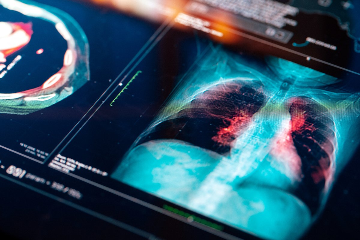 Latest research reveals that #LungDisease can increase the risk of #HeartDisease, independent of other risk factors. Looking at conventional factors such as age & smoking doesn't give the full picture of the relationship between these two systems. ➡️bit.ly/4auSaG7