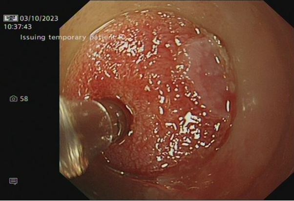 📰NEWS: Smart probe for oesophageal cancer diagnosis begins human trials

Read more here: tinyurl.com/4zftat33

<a href="/NIHRresearch/">National Institute for Health and Care Research</a> <a href="/UniofExeter/">University of Exeter</a> <a href="/BristolUni/">University of Bristol</a> <a href="/gloshospitals/">Gloucestershire Hospitals NHS Foundation Trust</a>