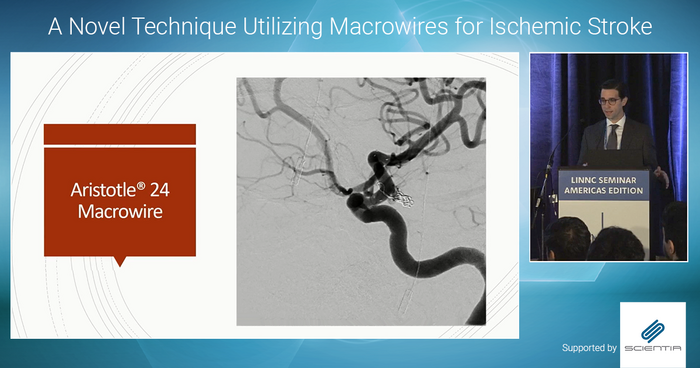 Dive into William Joseph Ares' symposium presentation on Macrowire technology, presented at #LINNCAmericas. Find out how this technology was harnessed in a recently published study, offering insights into efficacy of #Macrowire in #stroke care. ow.ly/6X6t50QWswg