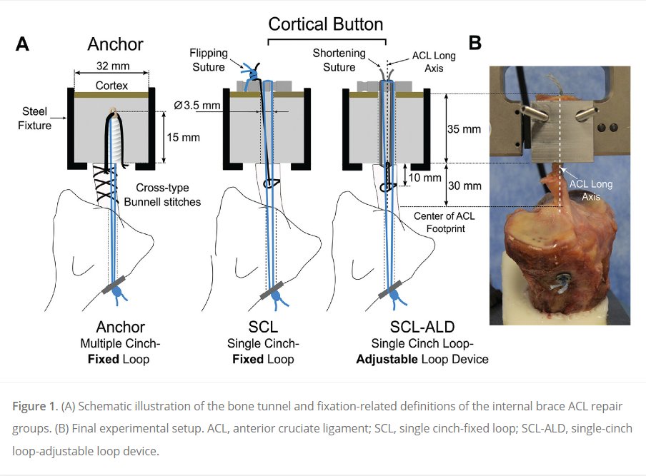 Adjustable #ACL repair improved the mechanical characteristics and reduced gap formation, but the overall clinical significance on healing remains unclear. #OrthoTwitter Read more #OpenAccess here! ow.ly/63Ah50QNMkl