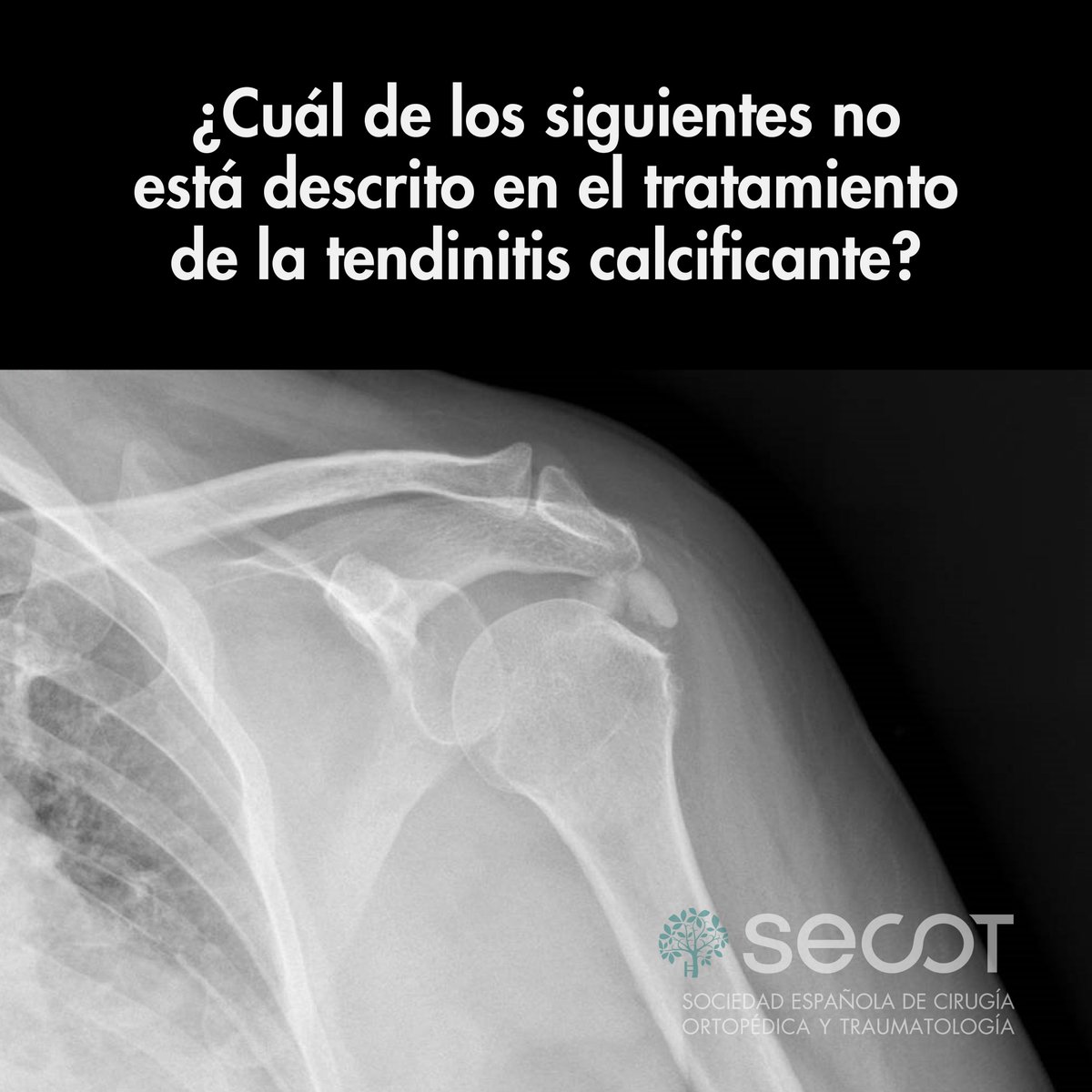Antes de las vacaciones de Semana Santa... ¡Vamos a por un #Ortolunes!

¿Cuál de los siguientes no está descrito en el tratamiento de la tendinitis calcificante?🤔