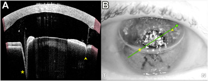 Image artifact on Swept Source Anterior Segment #OCT one day after #DMEK caused by the presence of the air-aqueous interface in the early post-op period. @EdmundTsuiMD @drsimonfung ow.ly/A9MM50QBPlY