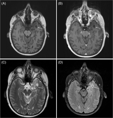 What is that in the #hippocampus? Learn how to identify lesions relevant to #braintumor #stroke #epilepsy #dementia and more in this review. #neurology #neurosurgery #neurotwitter #neuroscience #neurorad #radres #meded #anatomy #memory onlinelibrary.wiley.com/doi/10.1111/jo…