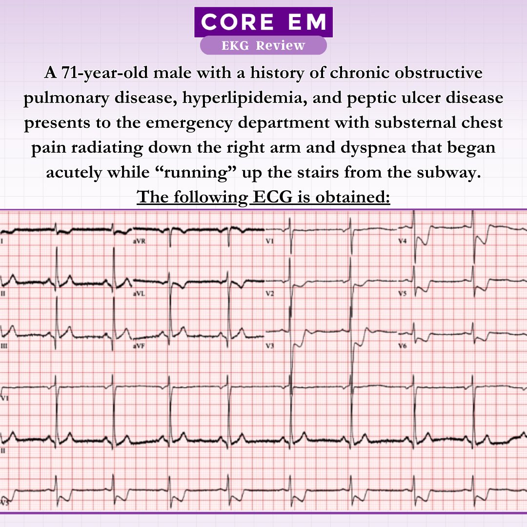 What stands out to you when you see this EKG?