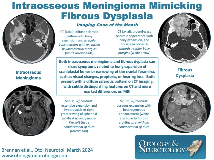 Intraosseous #Meningioma may mimic #FibrousDysplasia with symptomatology and CT imaging, with MRI useful in elucidating the pathology. #Neurotology. ow.ly/iPwx50QKkuv