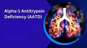 CheckOrphan's tweet image. A University of Birmingham (@unibirmingham) research shows how patients suffering from Alpha-1 antitrypsin deficiency ( #AATD ) are at higher risk of developing heart conditions - please check the link for more details  ow.ly/suoB50R1eE3   #rarediseases  #orphandrugs