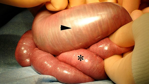 National shortage of gastrograffin in the UK until July 24. 
Whats is the effect on conservatively managed SBO? Alternatives less effective? Do you need osmotic activity?

SBO ACTION launching Mon 1st April 24.

Register your interest now at this link. 
forms.gle/bqCuL5xwjbBhtc…