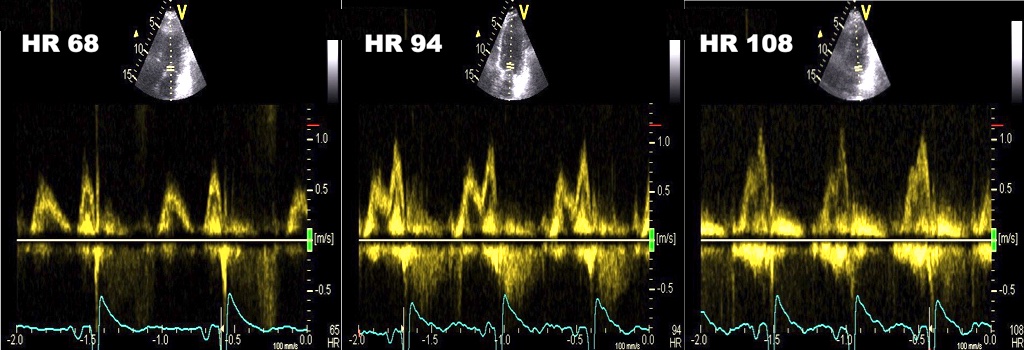 🧵1/ The E/A fusion in mitral flow with higher HR is well known, normally occurring around HR 100.