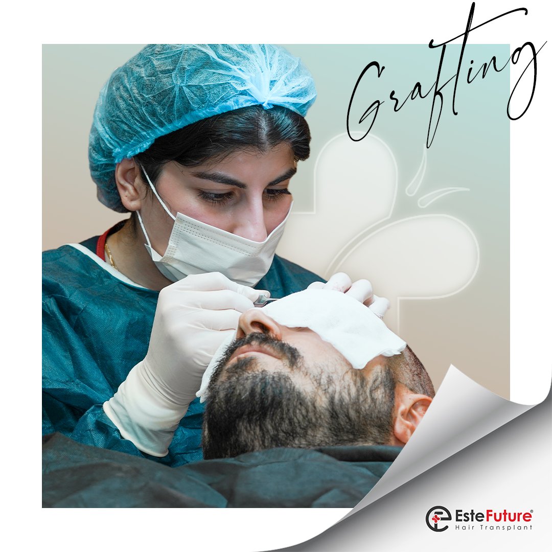este_future's tweet image. Grafts for hair transplantation are usually taken from the nape area where permanent hair follicles are located. This ensures natural and long-lasting results by using one's own hair. 

#hairtransplant #grafts #estefuture #grefts #hairhealth #hairtransplant #hairtransplantturkey