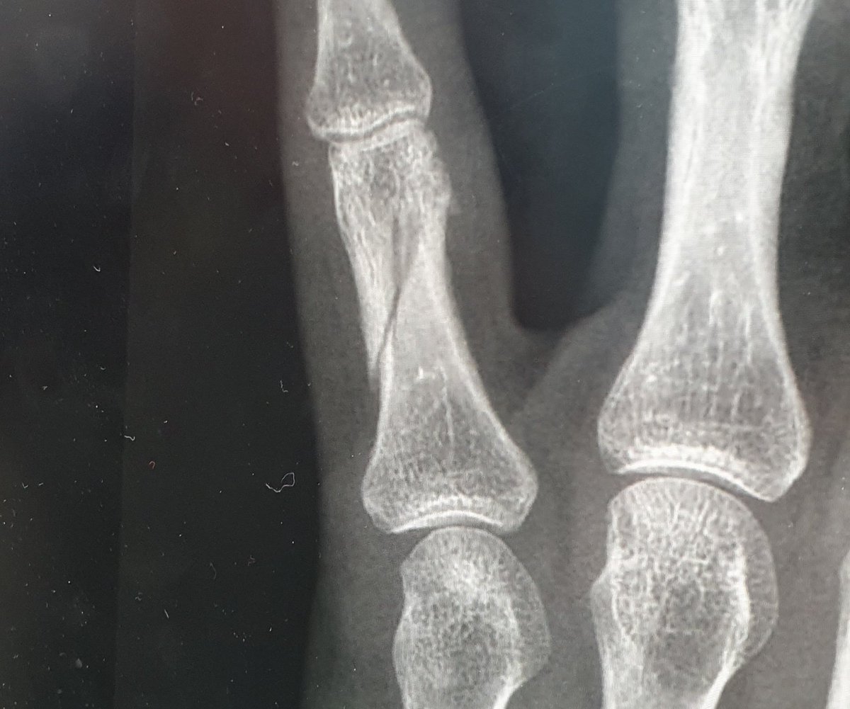 martinglester's tweet image. Well that explains why it has stung a bit for the last week #bugger