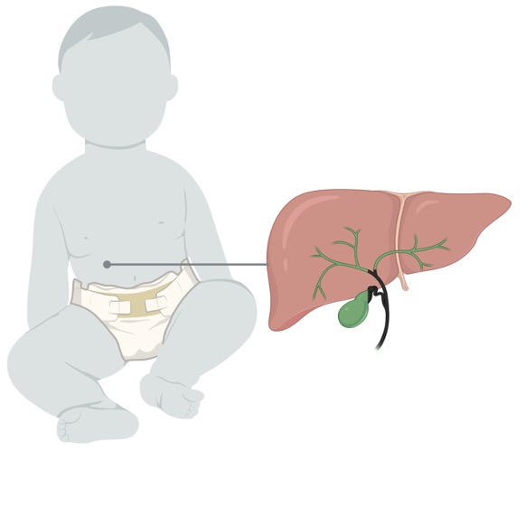 1/BILIARY ATRESIA remains the main indication for liver transplantation in children. Best outcomes are associated with early diagnosis and intervention. #livertwitter #pediatricsurgery #biliaryatresia #FIINDGreenInStool