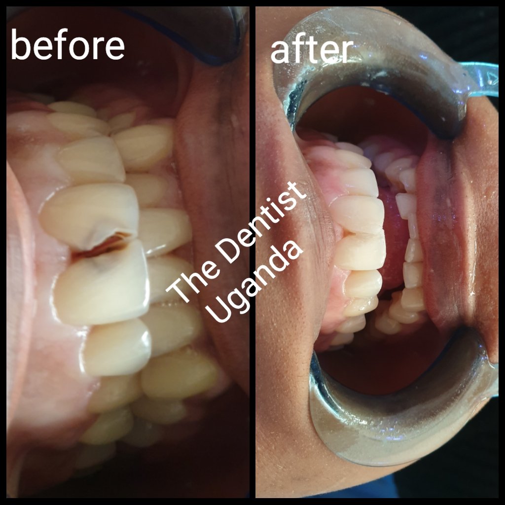 lightwelldent's tweet photo. Whatsap +256750952201 https://t.co/5hKkT4dVlf