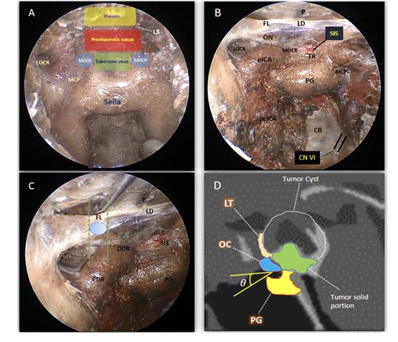 Mehdi Khaleghi MD (@mehdikhaleghii) on Twitter photo In our recent paper we described how establishing a small yet adequate working corridor based on the tumor-stalk relationship could effectively provide a safe optimal endoscopic endonasal removal of complex craniopharyngiomas. <a href="/PrevedelloDanny/">Danny Prevedello</a> <a href="/carrau_l/">ricardo l. carrau</a> In our recent paper we described how establishing a small yet adequate working corridor based on the tumor-stalk relationship could effectively provide a safe optimal endoscopic endonasal removal of complex craniopharyngiomas. <a href="/PrevedelloDanny/">Danny Prevedello</a> <a href="/carrau_l/">ricardo l. carrau</a>