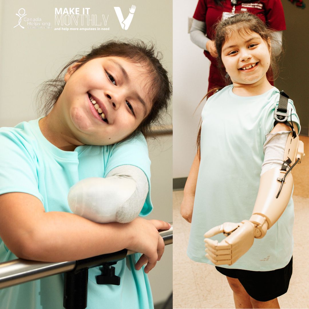 Its not too late to join our Monthly March campaign! Donating monthly directly supports Victoria Hand Project and gives you the chance to support prosthetic care. Help give #prosthetics to people like Giovanna whose smile only grew when she got her first prosthetic arm! 💙