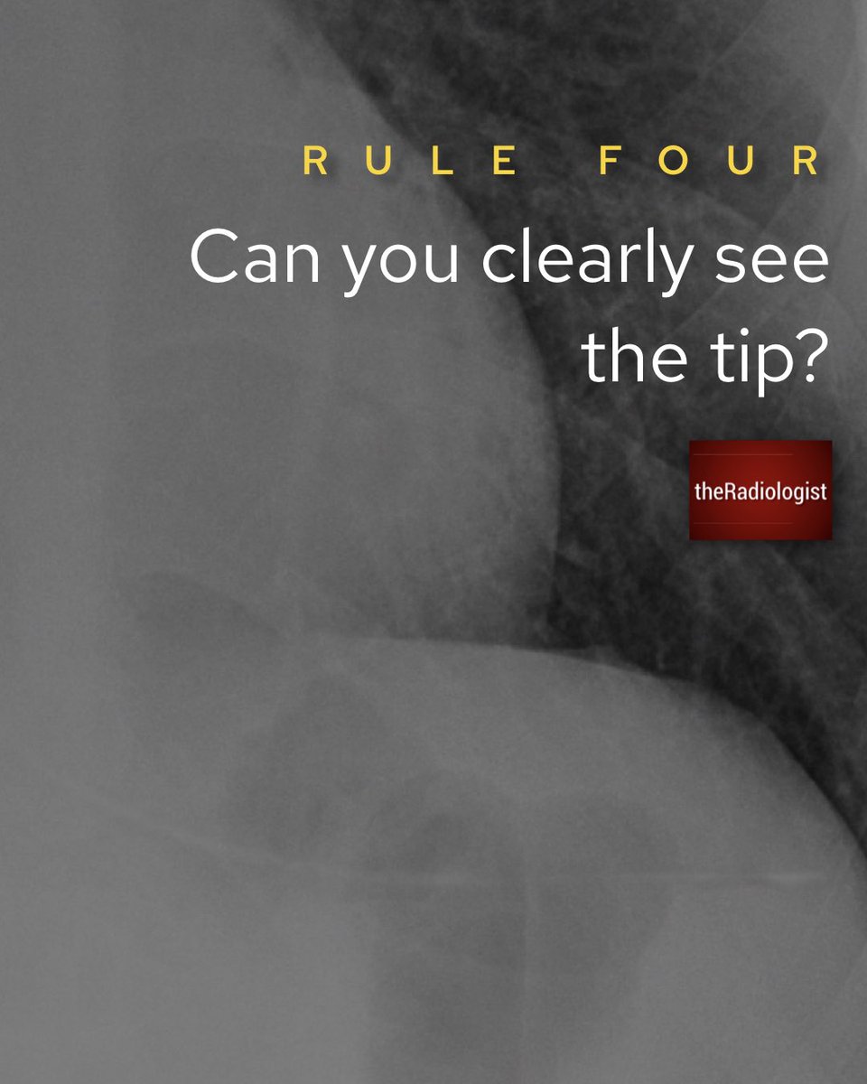 NG tube placement on Chest X-Ray: four rules to follow