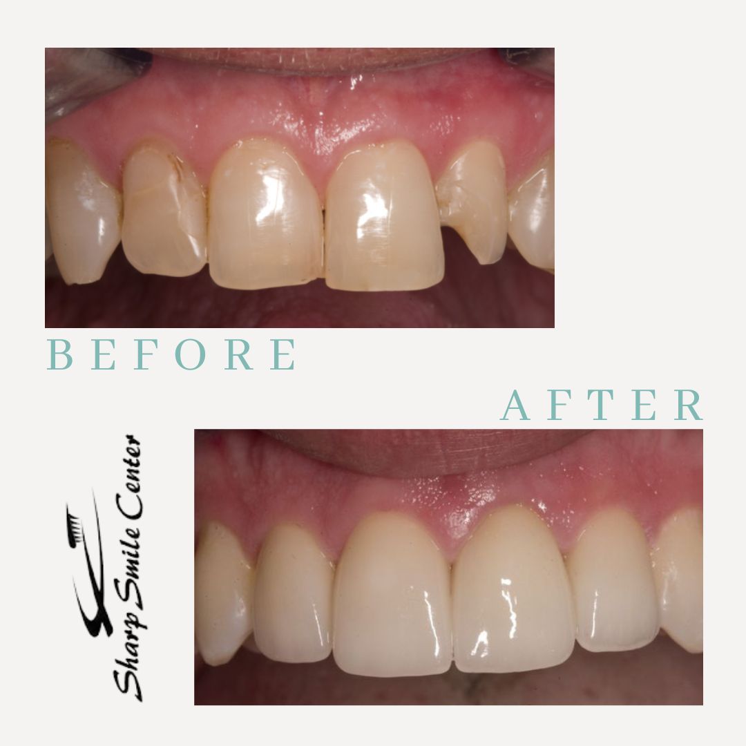 MichaelSharpDDS's tweet image. #MondayMakeover

If you are self-conscious of your smile, advanced cosmetic dentistry techniques can address dental flaws in a remarkably short amount of time. 

SSC is here to give you your confidence back! 

Call us at 269-344-4004 📱
---
 #SSC #PortageDentist #KalamazooDentist