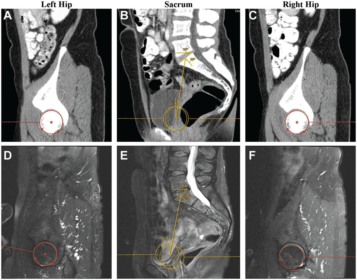 AOSSM Journals (@aossmjournals) on Twitter photo New study from <a href="/MassGenBrigham/">Mass General Brigham</a> reveals the important effect of spinopelvic alignment on #HipArthroscopy outcomes for acetabular labral tears and #FemoroacetabularImpingement. #OpenAccess
<a href="/SDMartinMD/">Dr. Scott Martin</a> <a href="/kavehtorabian/">Kaveh Torabian</a>
doi.org/10.1177/036354… New study from <a href="/MassGenBrigham/">Mass General Brigham</a> reveals the important effect of spinopelvic alignment on #HipArthroscopy outcomes for acetabular labral tears and #FemoroacetabularImpingement. #OpenAccess
<a href="/SDMartinMD/">Dr. Scott Martin</a> <a href="/kavehtorabian/">Kaveh Torabian</a>
doi.org/10.1177/036354…