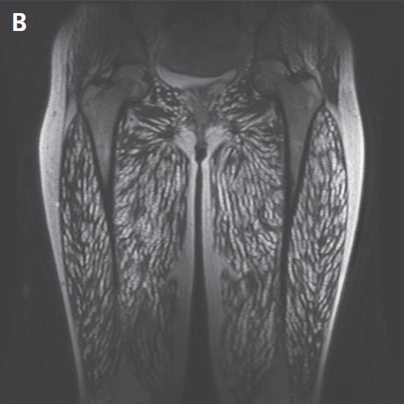 Elevated IgE in this patient… diagnosis? (Source: NEJM)