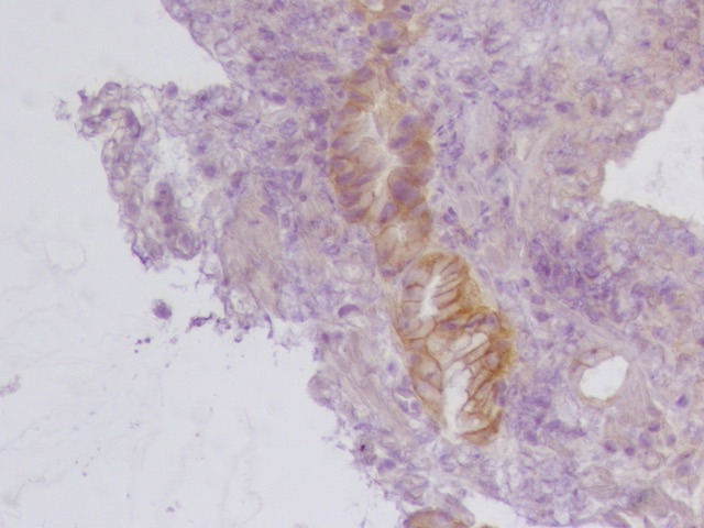 Dear #GIPath #HER2 #Gastricancer Another exercise on HER2 on gastric cancer Need consensus Score? @Greg_Charville @RunjanChetty @Vik_deshpandeMD @IHC_guy @DrMarkOng @drtimbracey @RAStandish @Mvgs1706 @DraEosina @KStashMD @GIJamesMD