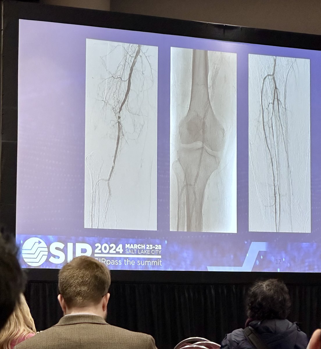 Great #ShockwaveIVL case presentation at #SIR24SLC by Dr @drvarshana. Dr Gurusamy reviewed a calcified popliteal case where she improved inflow to the foot with IVL. US Rx only. ISI bit.ly/3iEq7fC #IRad @SIRspecialists