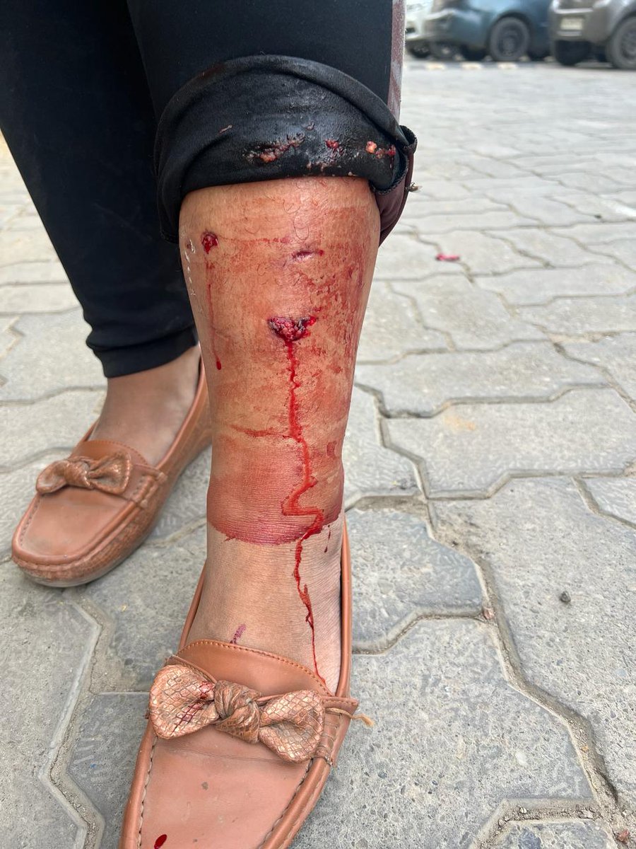 ThakurKaBeta's tweet image. गाजियाबाद के राज नगर एक्सटेंशन के #KDP सोसाइटी में कुत्तों का एक बार फिर दिखा आतंक। इस बार कुत्तों ने अपने फ्लैट जा रही युवती को अपना शिकार बनाया। सोसाइटी के अध्यक्ष और गाजियाबाद पुलिस साथ ही नगर निगम किसी के मरने का इंतेजार कर रहा है। सोसाइटी में अवारा कुत्तों की भरमार है।