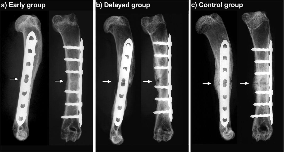 The prolonged duration of infection appears to disrupt the process of bone healing to such an extent that even after clearance of the infection, bone healing no longer proceeds. #BJR #BoneHealing #OpenAccess ow.ly/uAec50R0RIr