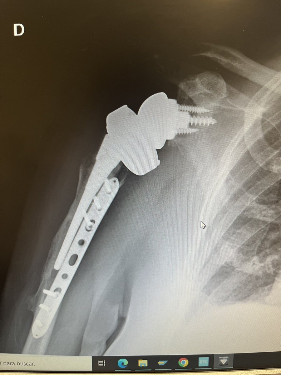 🛑4 years between first x ray and today in Allograft-Prosthetic Composite Reconstruction for massive proximal humeral bone loss. Patient is asymptomatic. Should we worry? <a href="/sechc_oficial/">SECHC</a> <a href="/JSanchezSotelo/">Dr.J.Sanchez-Sotelo</a>
