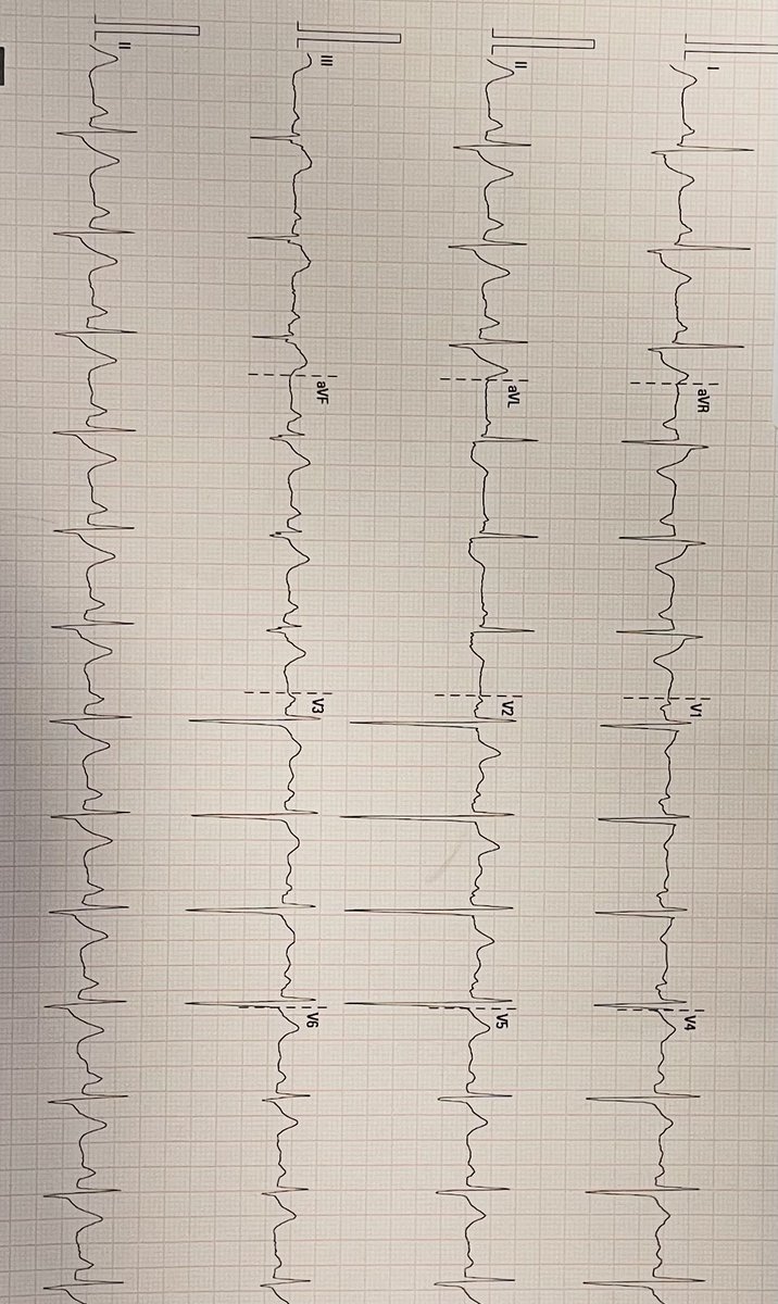 Andrew SP Sharp (@drandrewsharp) on Twitter photo (PWP)
Young man in his late thirties, presents with ongoing chest pain, but stable and looks well. Diagnosis? (PWP)
Young man in his late thirties, presents with ongoing chest pain, but stable and looks well. Diagnosis?