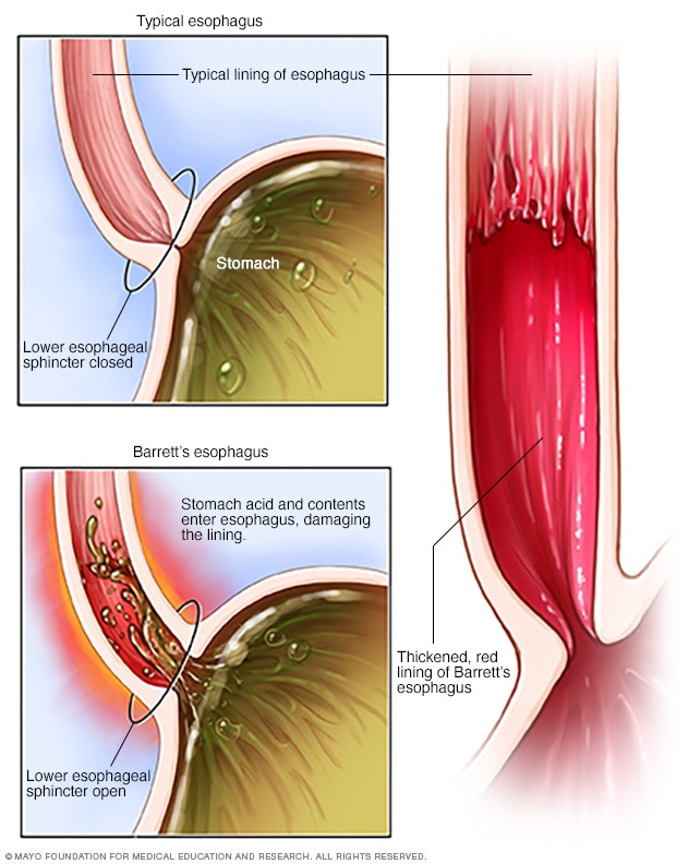 Itebimien Peter (@peteritebimien) on Twitter photo <a href="/modernHealthMe/">Modern Health</a> Barrett's esophagus is a condition in which there is an abnormal (metaplastic) change in the mucosal cells lining the lower portion of the esophagus, from stratified squamous epithelium to simple columnar epithelium with interspersed goblet cells that are normally present only in <a href="/modernHealthMe/">Modern Health</a> Barrett's esophagus is a condition in which there is an abnormal (metaplastic) change in the mucosal cells lining the lower portion of the esophagus, from stratified squamous epithelium to simple columnar epithelium with interspersed goblet cells that are normally present only in