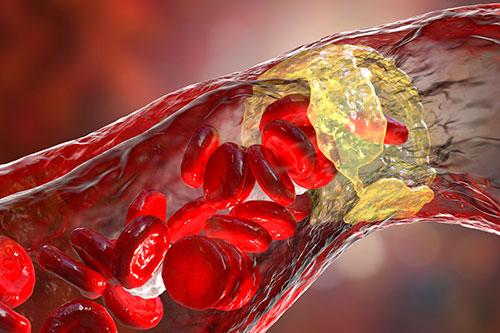 Take a look at our summary of latest CLEAR Outcomes trial data on #PCSK9 Forum showing #bempedoic acid reduces recurrent as well as first major adverse #cardiovascular events &gt;&gt; pcsk9forum.org/clear-outcomes… 
#CLEAROutcomes #atherosclerosis  #heartattack #PCSK9Forum #JAMACardiology