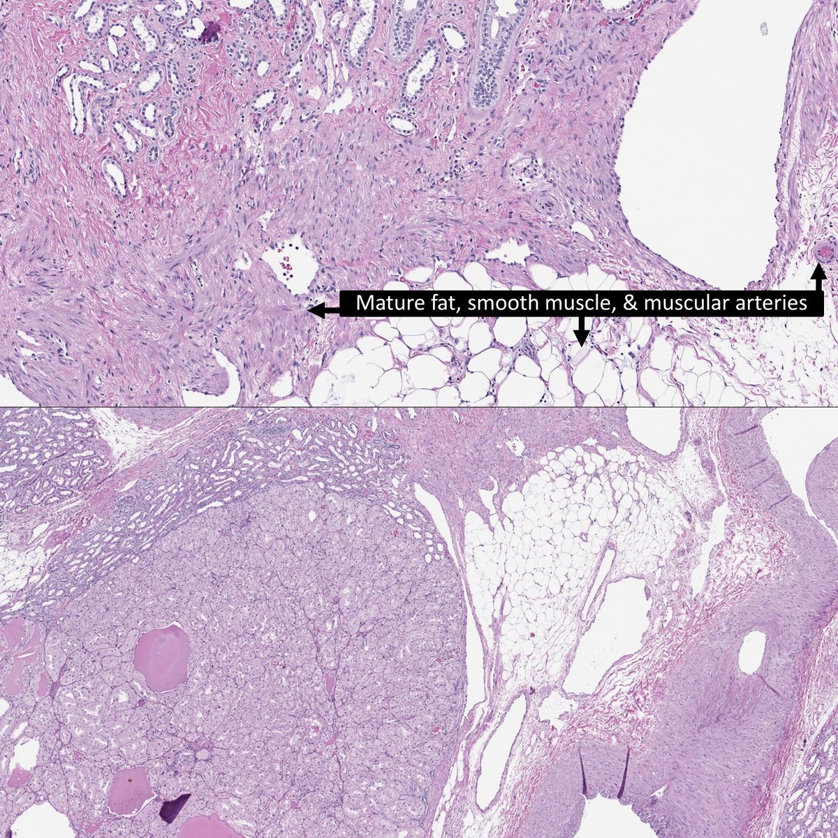 3 renal tumors, 1 genetic disease
A) Hereditary leiomyomatosis & RCC Syndrome
B) Hereditary Paraganglioma-Pheochromocytoma Syndrome
C) Tuberous sclerosis
🔬🙏Dr. Victor Reuter at #USCAP
conferences.aiforia.com/Public/USCAP/0…
#RenalPath #GUPath #PathTwitter #PathResidents #USCAP2024 #USCAP24