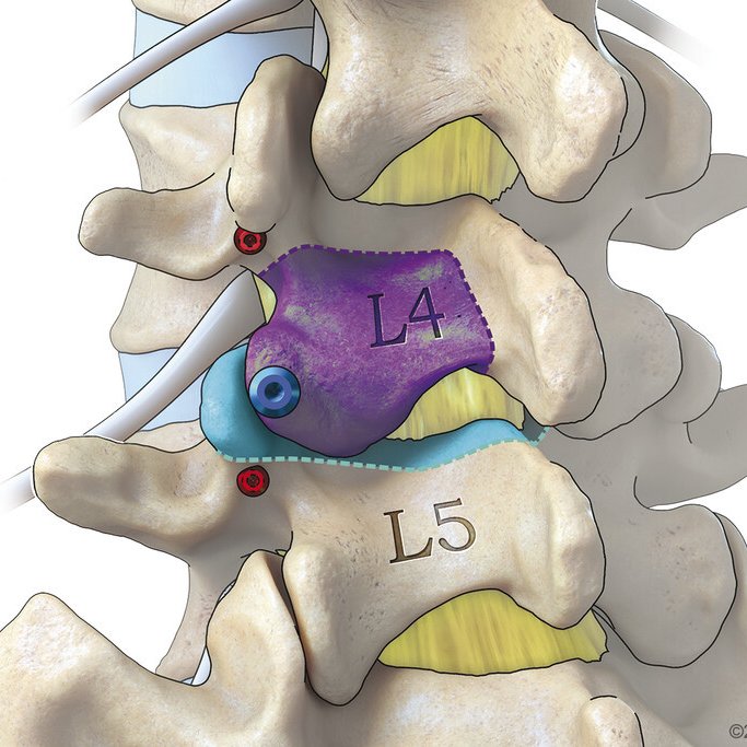 ratnayakemd's tweet photo. The requisite anatomy for an approach to the minimally invasive TLIF.

Red dots - Pedicle screw start points
Blue dot - Initial dilator docking point
Dashed lines - Osteotomy cuts https://t.co/3JpZ0dPxpu