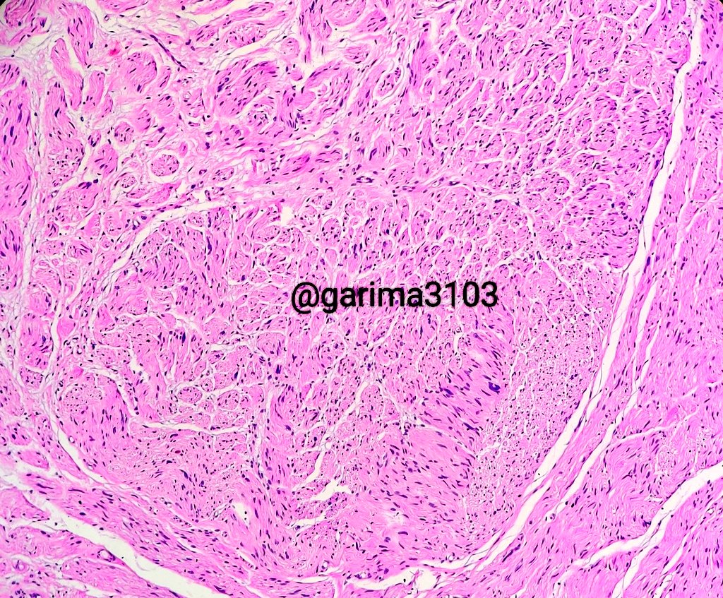 Post surgery and neck dissection
Nodular lesion on ipsilateral neck - excised as neck node
It's a traumatized.......... 🎯
#PathTwitter #pathtweetaward #headandneckpath #surgpath