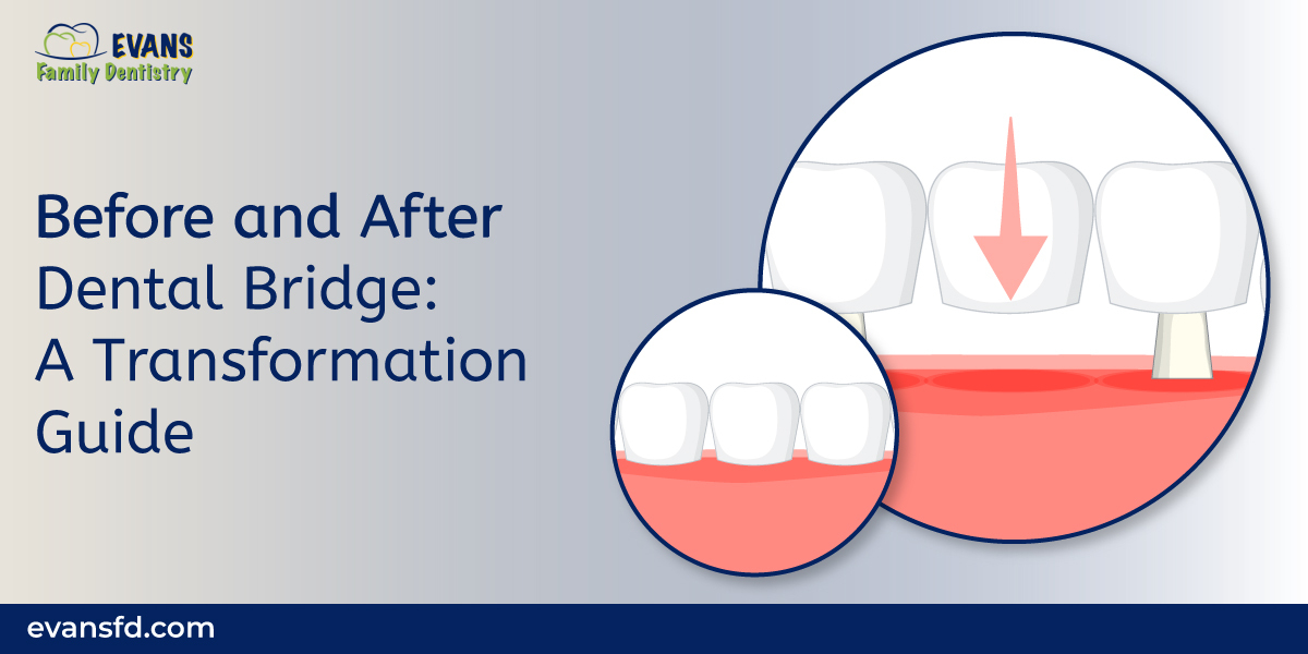 EvansDentistry's tweet image. Our latest Before and After Dental Bridge guide showcases the magic of Dental Bridges.

Say goodbye to gaps and hello to a complete, confident smile. Explore more -evansfd.com/before-and-aft…

#dentalbridge #transformationguide #dentaltreatment #dentistry #EvansDentalCare #oralhealth