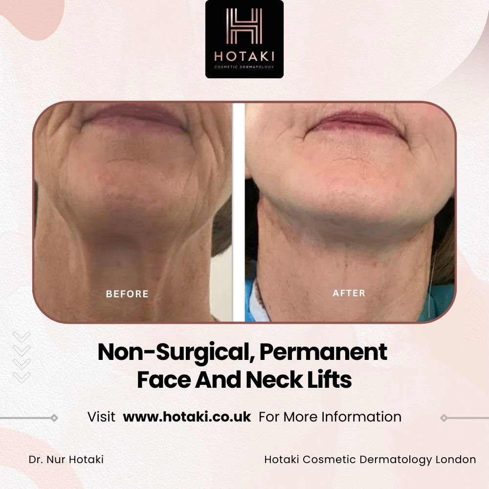 #drhotaki #hotakilondon #nonsurgicalaesthetics #aesthetictreatment #hotakicosmeticdermatology #noninvasive #nonsurgical #lowernecklift #nonsurgicallowernecklift #nonsurgical #nonsurgicalnecklift #facialrejuvenation #lowernecklift #necklift #necklifts #nonsurgicalnecklifts