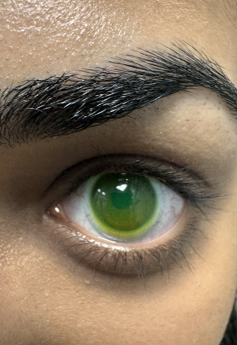 mrj_vision's tweet image. Last week our final year students @PlymOptometry had hands-on experience in fitting and assessing mini-scleral contact lens. Thanks to Ian Sexton from @CooperVisionUK in helping to run this workshop. #miniscleral #specialitycontactlens