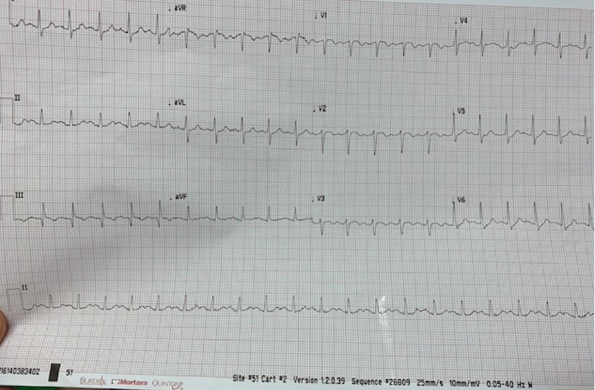 A man in his 50s with shortness of breath hqmeded-ecg.blogspot.com/2024/03/a-man-… @PendellM
