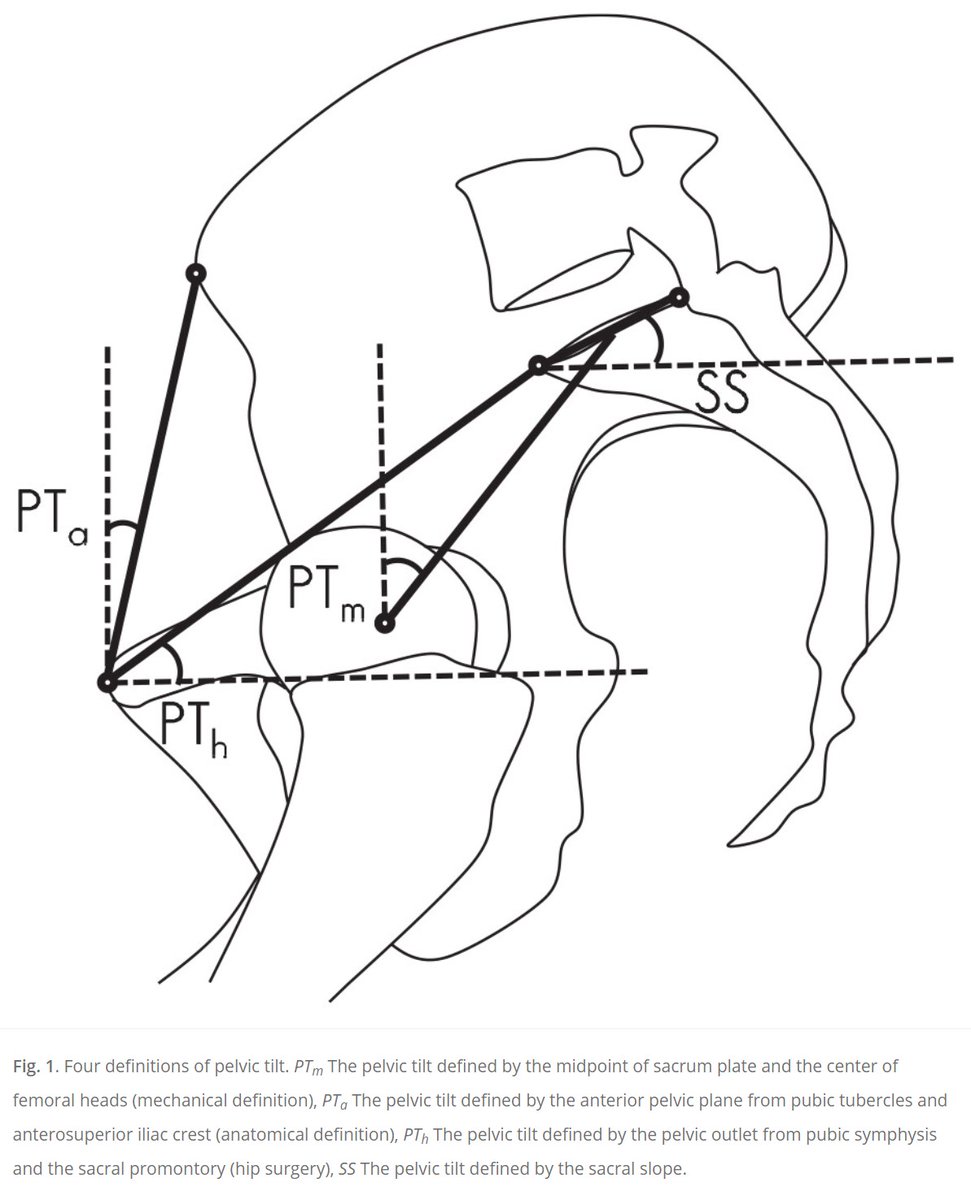 Pelvic tilt is useful in assessing global sagittal alignment in pts w/ #SpinealDeformity & influences navigation in #HipSurgey. #ICYMI authors from @SydneyMSK published 'Correlations Analysis of Different Pelvic Tilt Definitions: A Preliminary Study': journals.sagepub.com/doi/full/10.11…