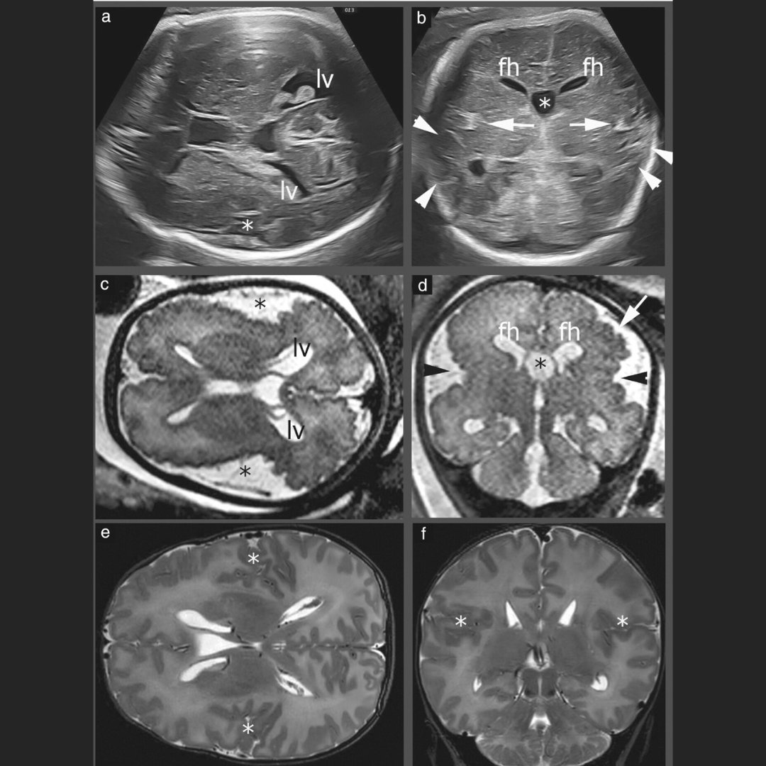 ISUOG's tweet photo. In a new #UOGJournal Opinion, Paladini et al. describe the neurosonographic features of cerebral lesions considered to be fetal precursors of polymicrogyria https://t.co/MQRCnp3COd https://t.co/wCNFIO9Gp7