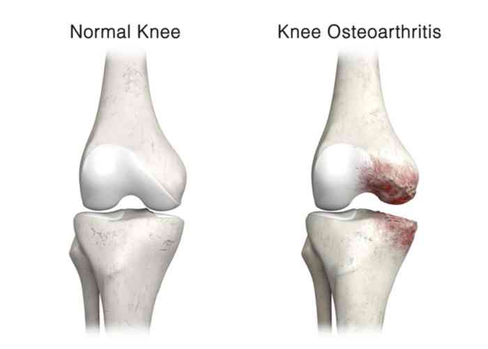 The progression of osteoarthritis: From Grade 1 with softening of cartilage to Grade 4 with complete wear and bone exposure. Understanding these stages can help manage and treat this condition. medilink.us/z9m9 #Arthritis #BoneHealth